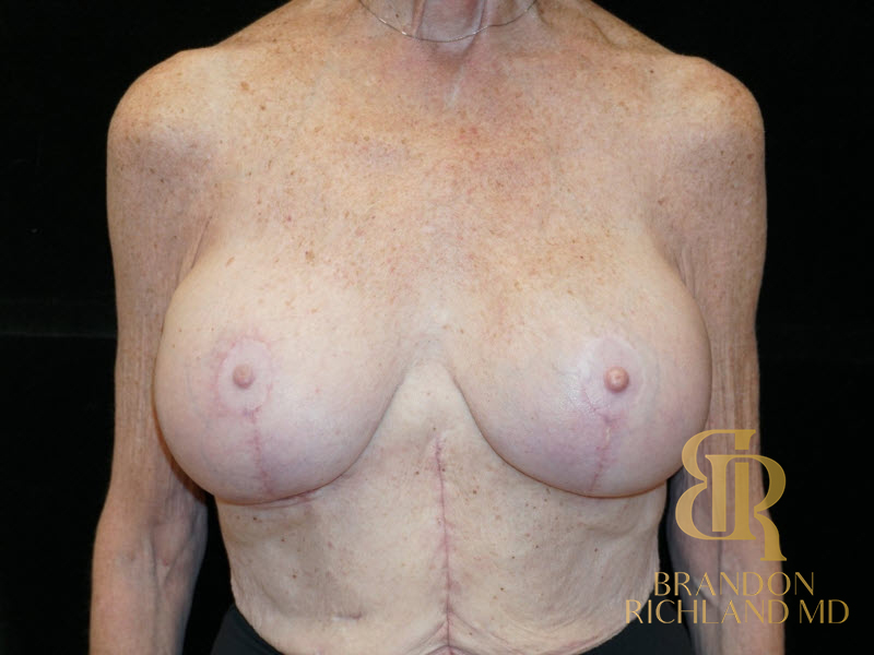 Breast Augmentation & Lift Before & After Image