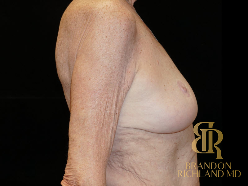 Breast Augmentation & Lift Before & After Image