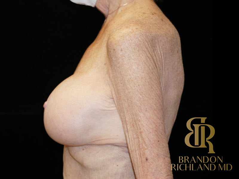 Breast Augmentation & Lift Before & After Image