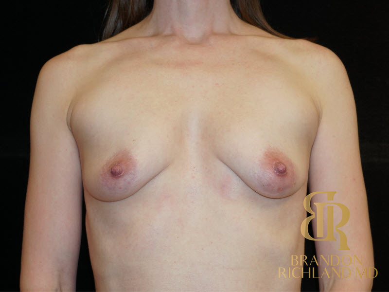 Breast Augmentation & Lift Before & After Image