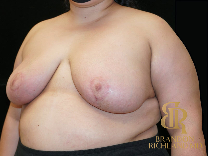 Breast Augmentation & Lift Before & After Image