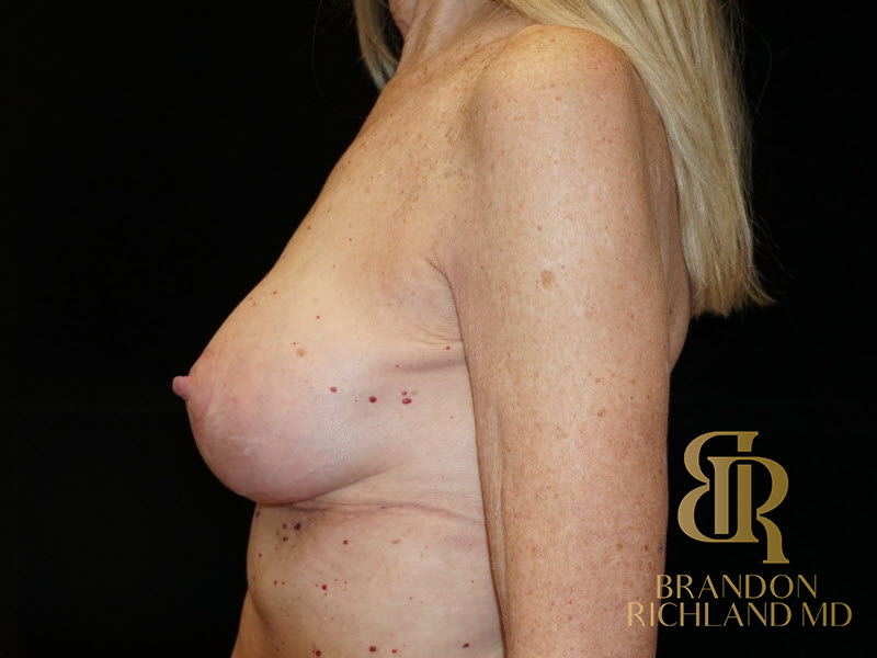 Breast Augmentation Before & After Image