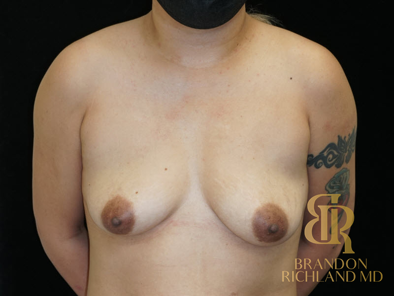 Breast Augmentation Before & After Image