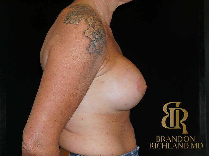 Breast Augmentation Before & After Image
