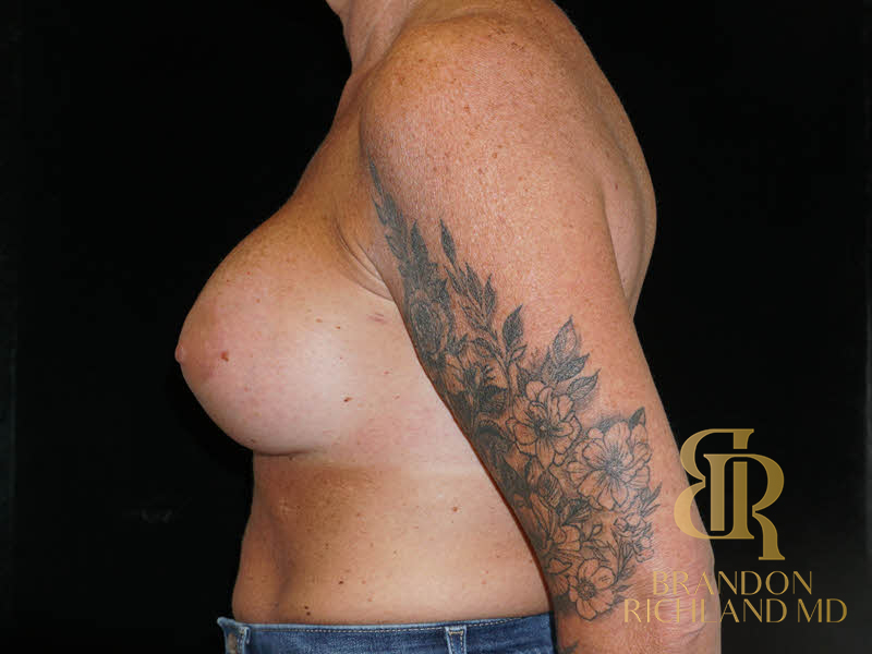 Breast Augmentation Before & After Image