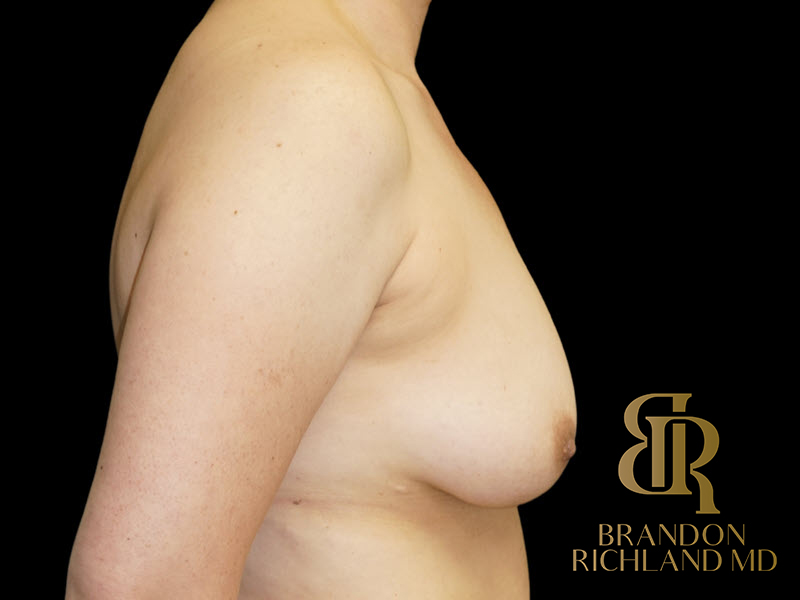 Breast Augmentation Before & After Image