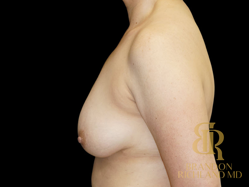 Breast Augmentation Before & After Image