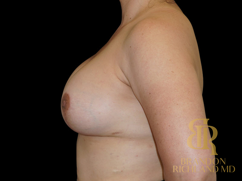 Breast Augmentation Before & After Image