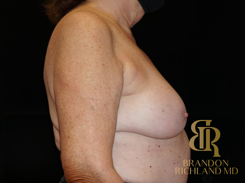 Breast Implant Removal Before & After Image