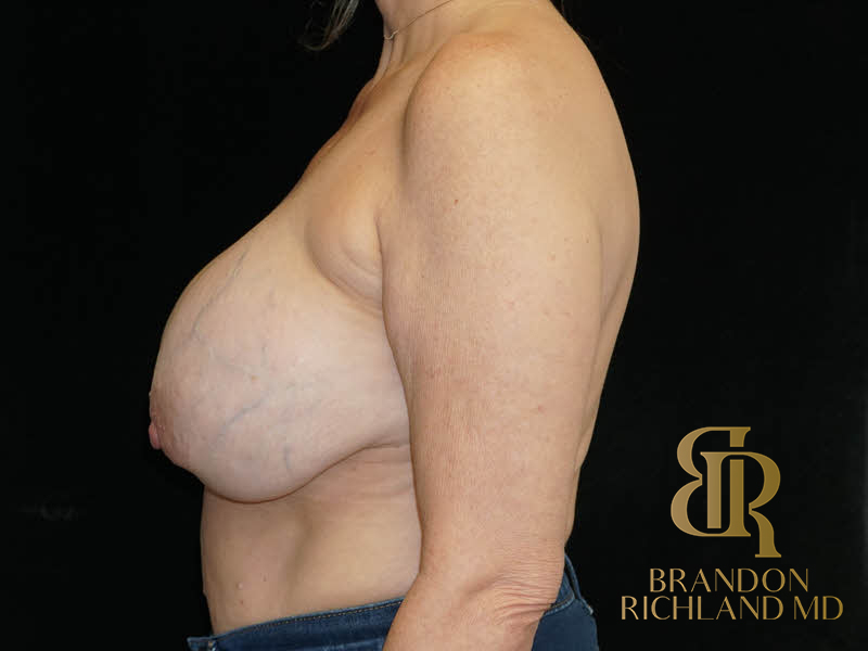 Breast Implant Removal Before & After Image