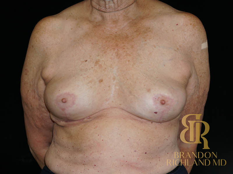 Breast Implant Removal Before & After Image