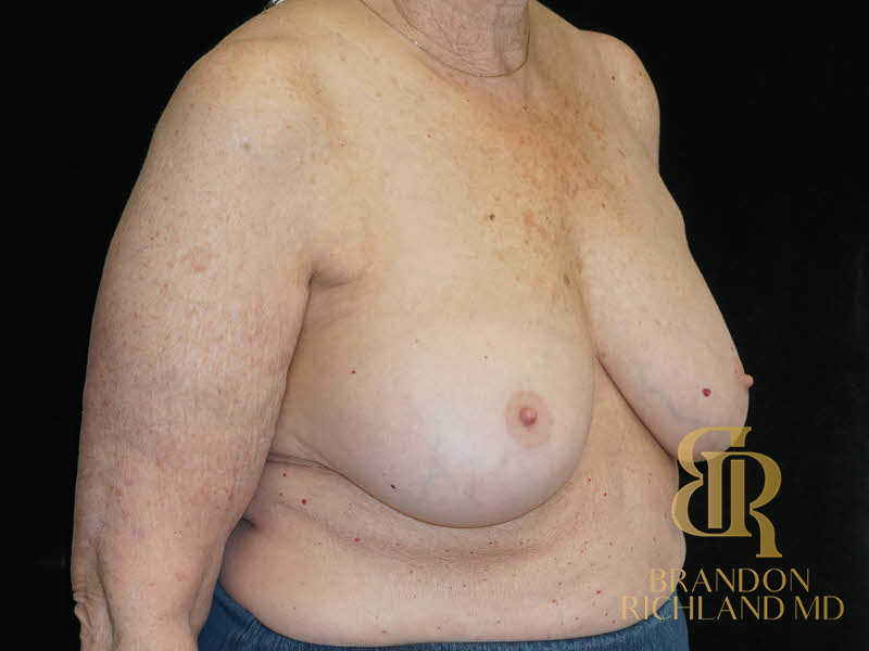 Breast Implant Removal Before & After Image