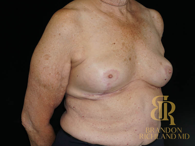 Breast Implant Removal Before & After Image