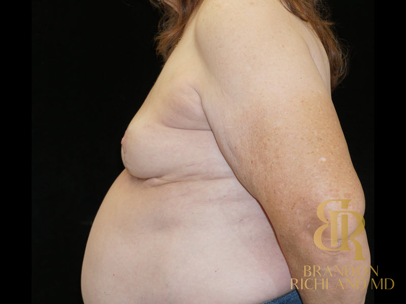 Breast Implant Removal Before & After Image