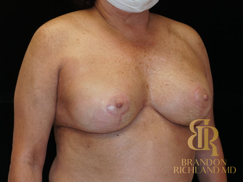 Breast Lift with Implants Before & After Image