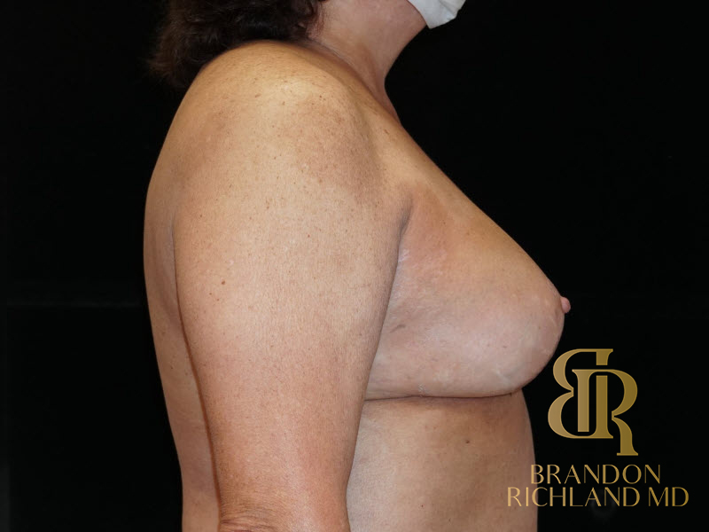 Breast Lift with Implants Before & After Image