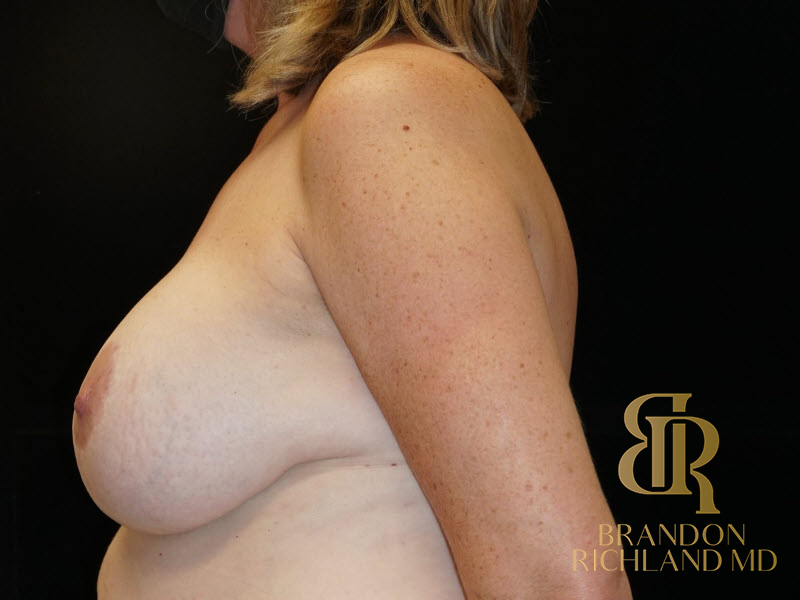 Breast Lift with Implants Before & After Image