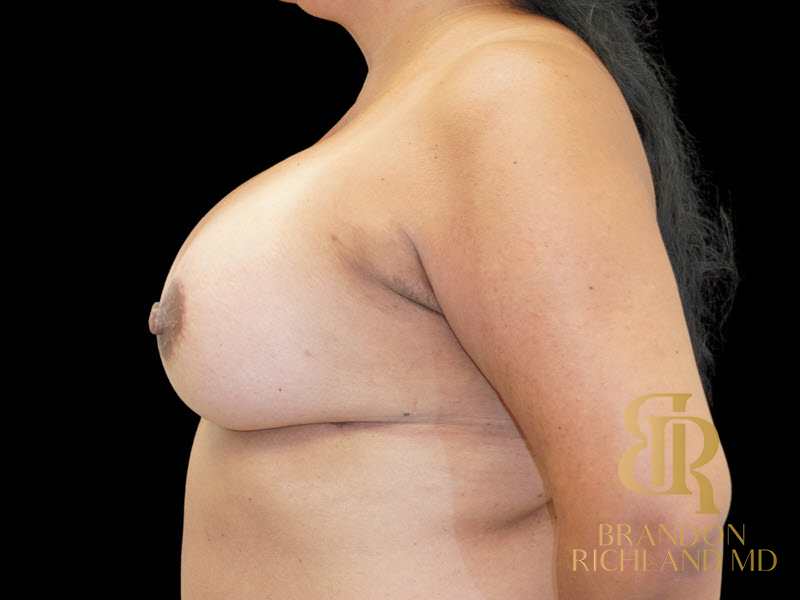 Breast Lift with Implants Before & After Image