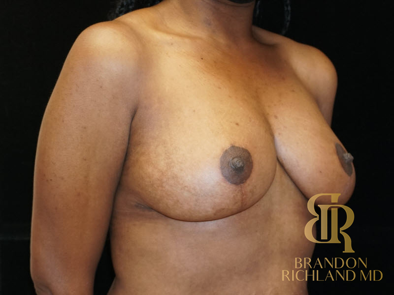 Breast Lift Before & After Image