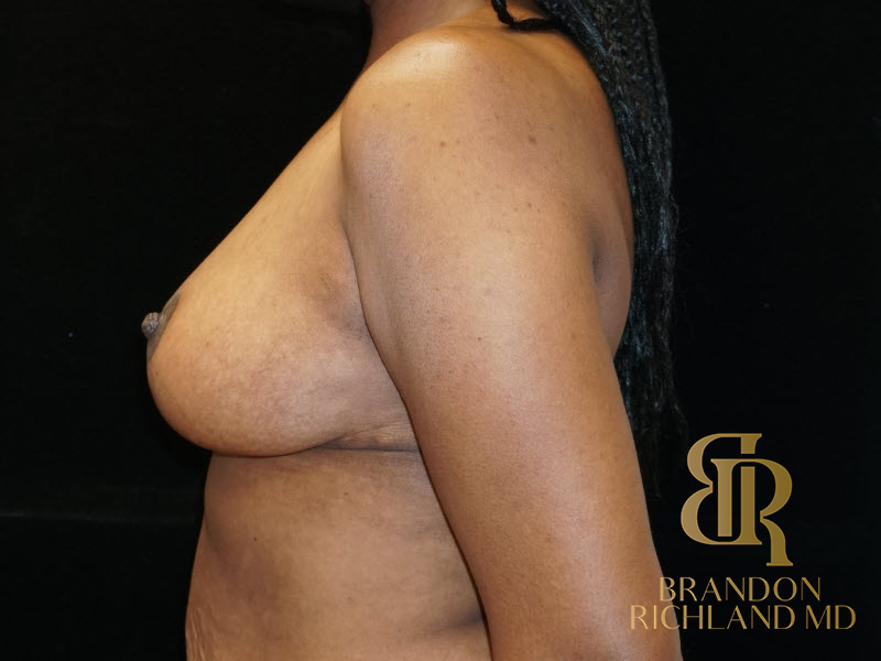 Breast Lift Before & After Image