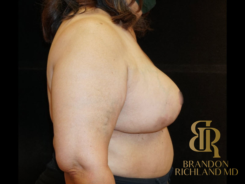 Breast Lift Before & After Image