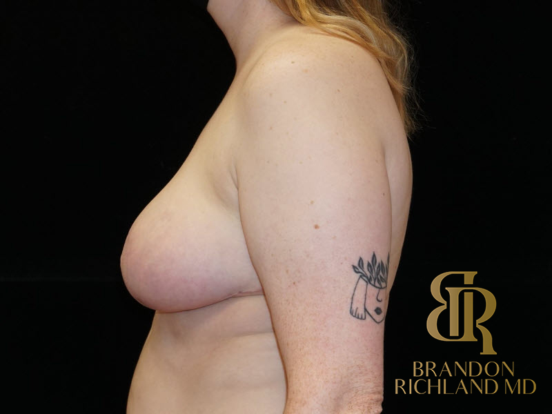 Breast Lift Before & After Image