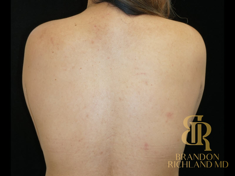 Breast Lift Before & After Image