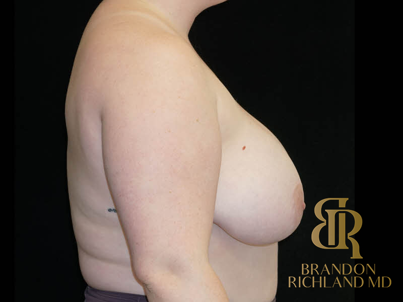 Breast Lift Before & After Image