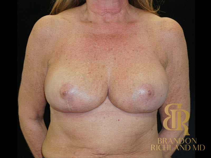 Breast Lift Before & After Image