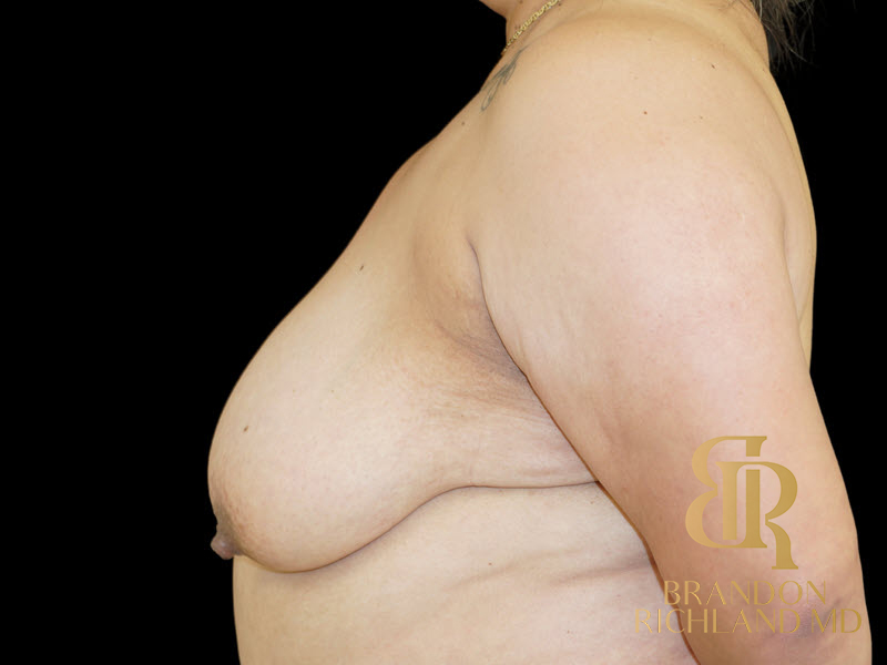 Breast Lift Before & After Image