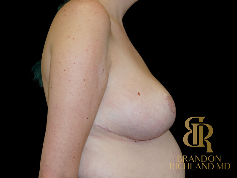 Breast Lift Before & After Image