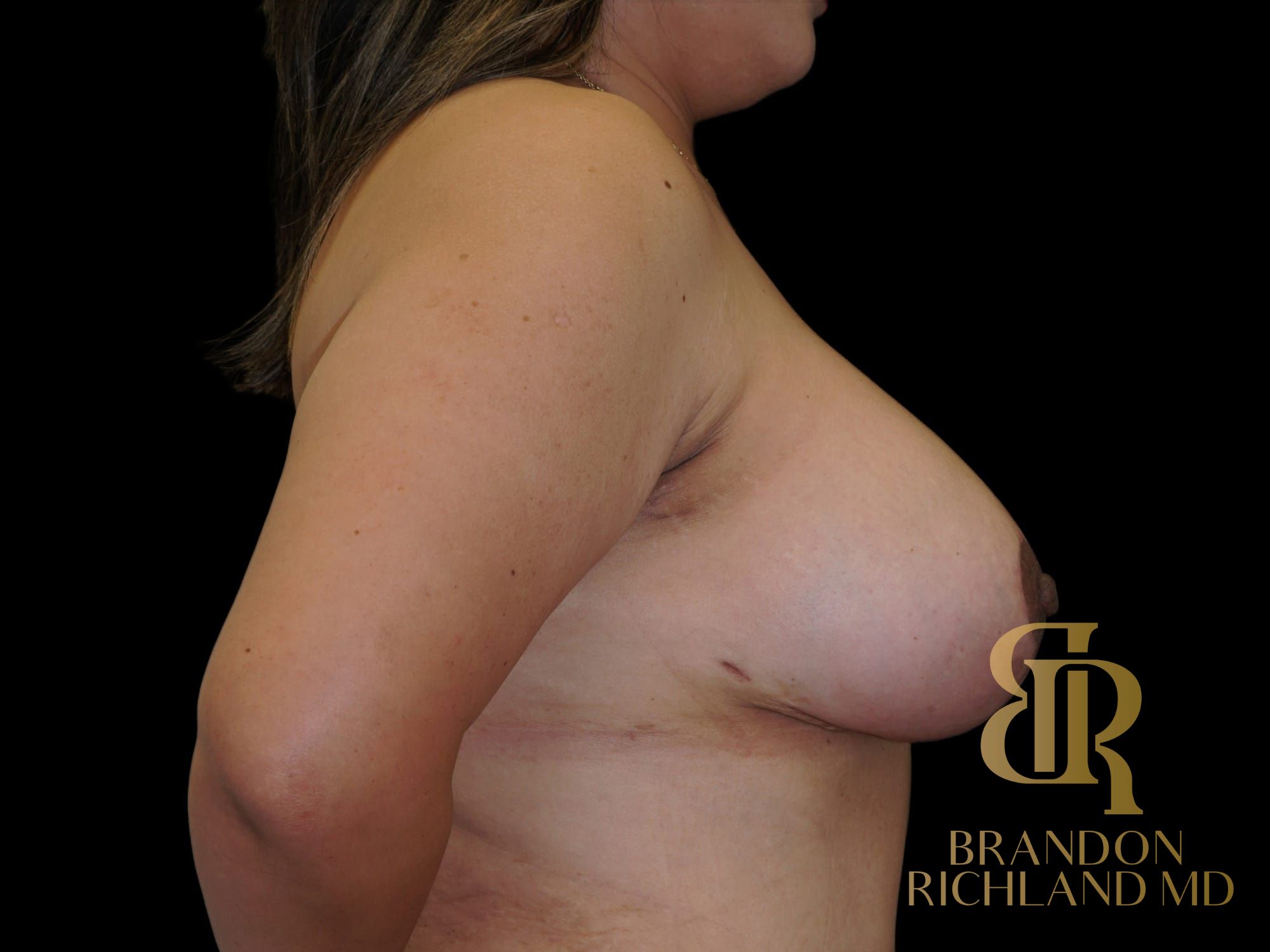 Breast Lift Before & After Image