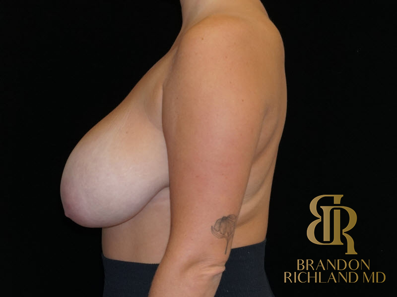 Breast Reduction Before & After Image