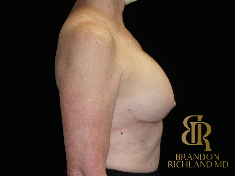 Breast Revision Before & After Image