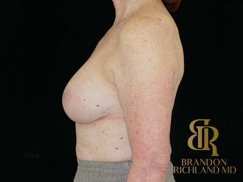 Breast Revision Before & After Image