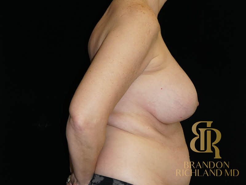 Breast Revision Before & After Image