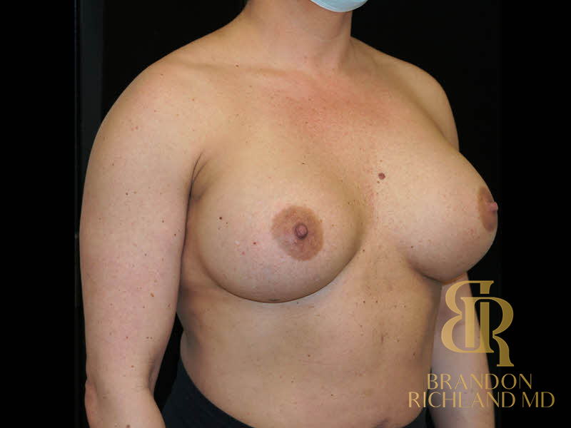 Breast Revision Before & After Image