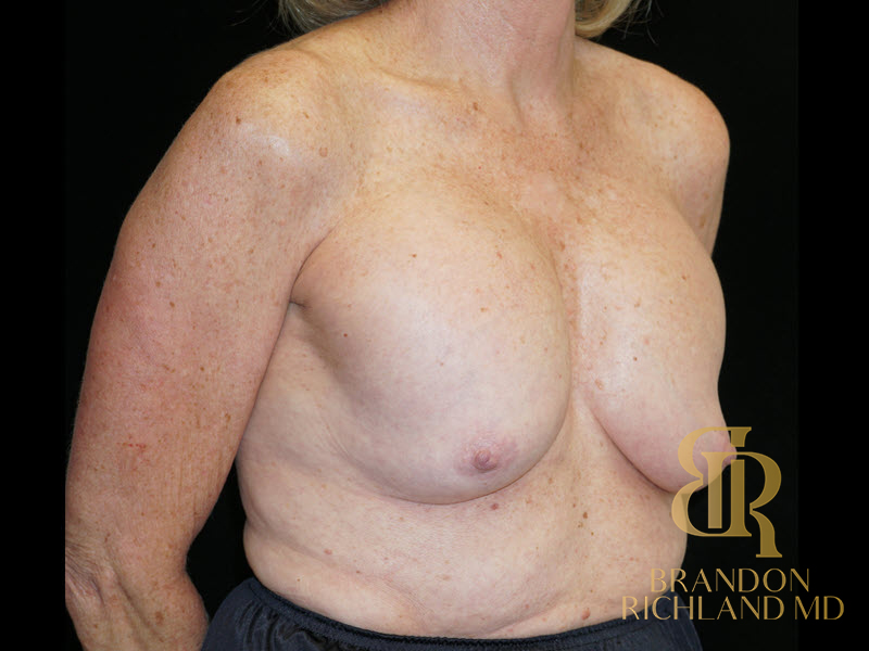 Breast Revision Before & After Image