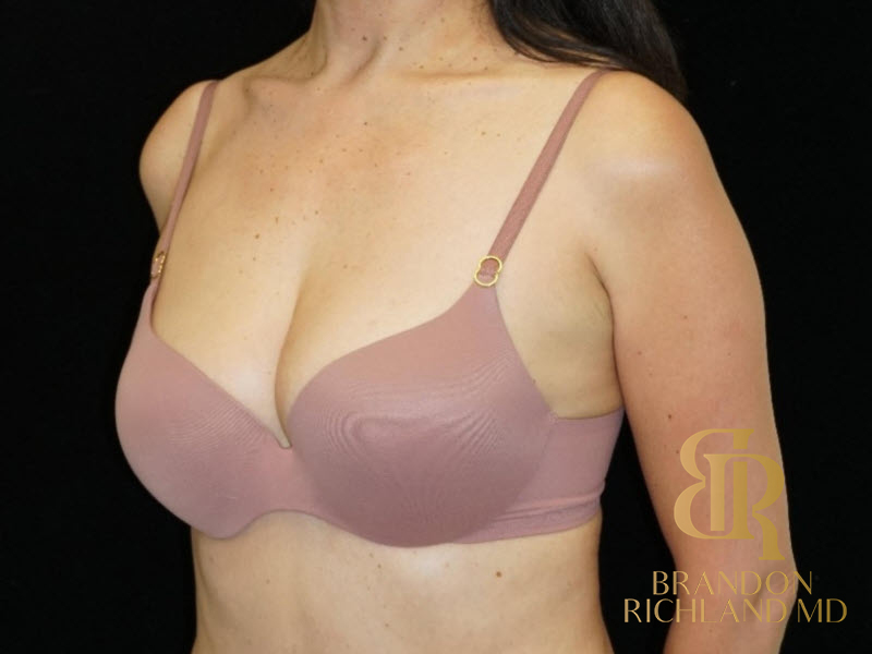 Fat Transfer Breast Augmentation Before & After Image