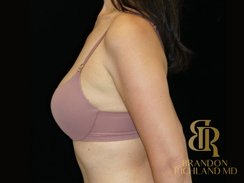 Fat Transfer Breast Augmentation Before & After Image