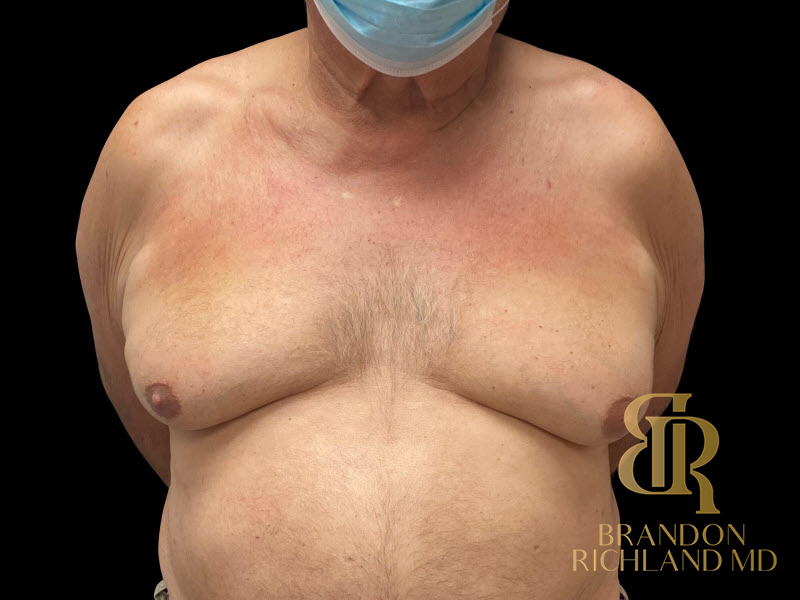 Gynecomastia Surgery Before & After Image