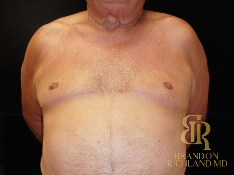 Gynecomastia Surgery Before & After Image