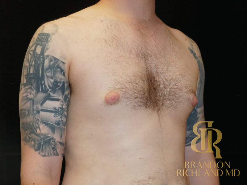 Gynecomastia Surgery Before & After Image