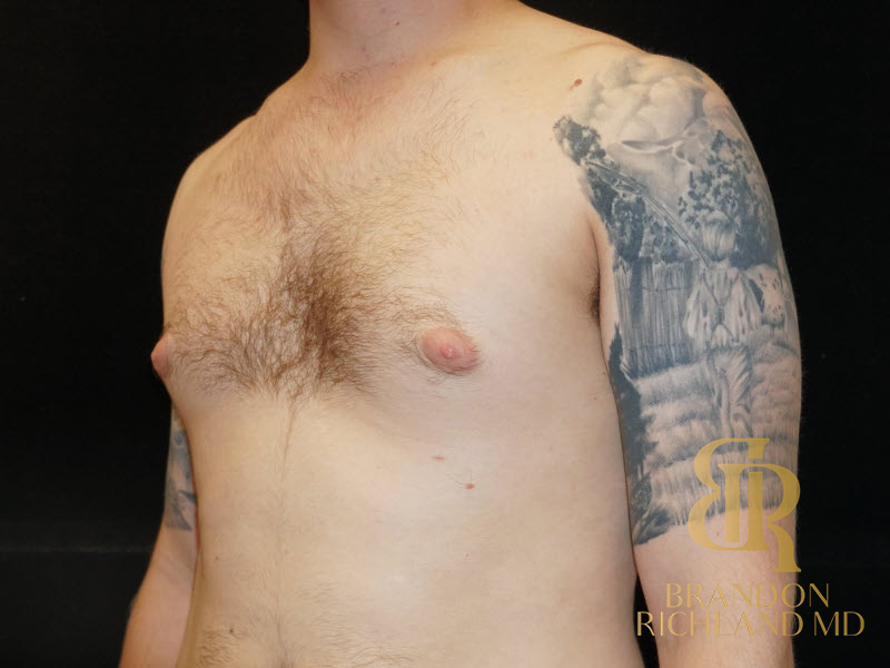 Gynecomastia Surgery Before & After Image