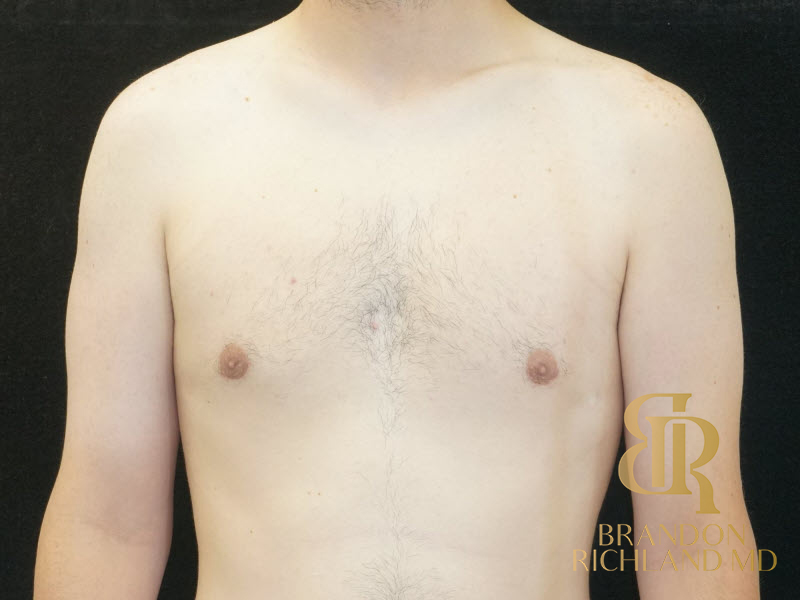 Gynecomastia Surgery Before & After Image