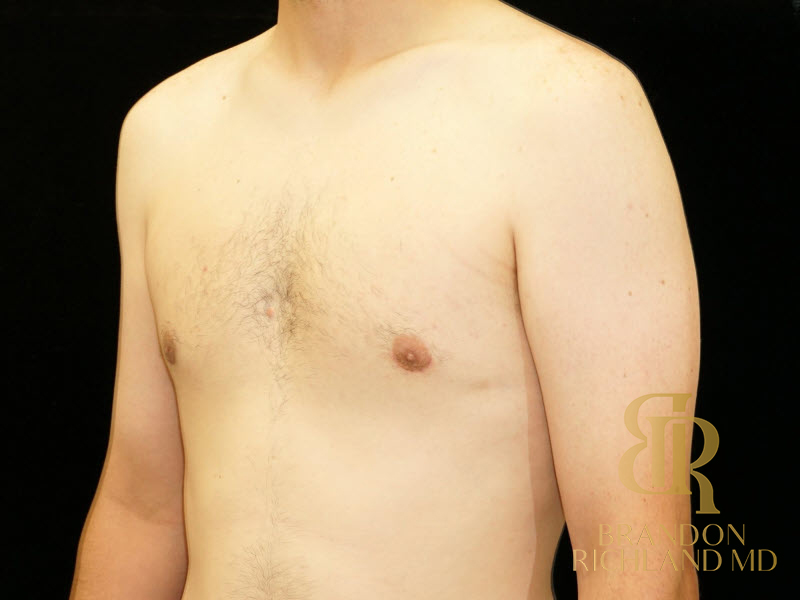 Gynecomastia Surgery Before & After Image