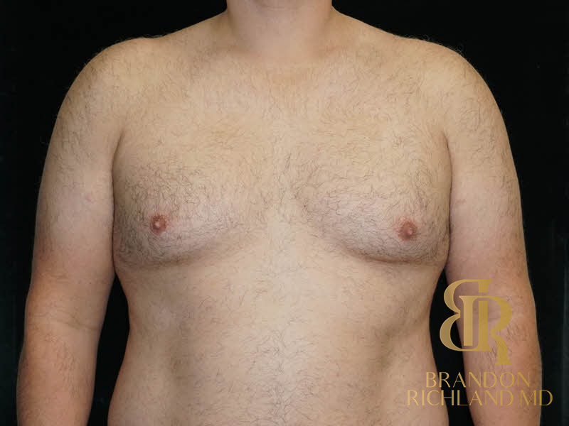 Gynecomastia Surgery Before & After Image