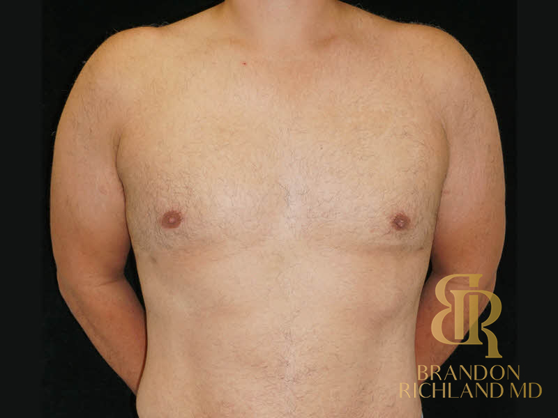 Gynecomastia Surgery Before & After Image