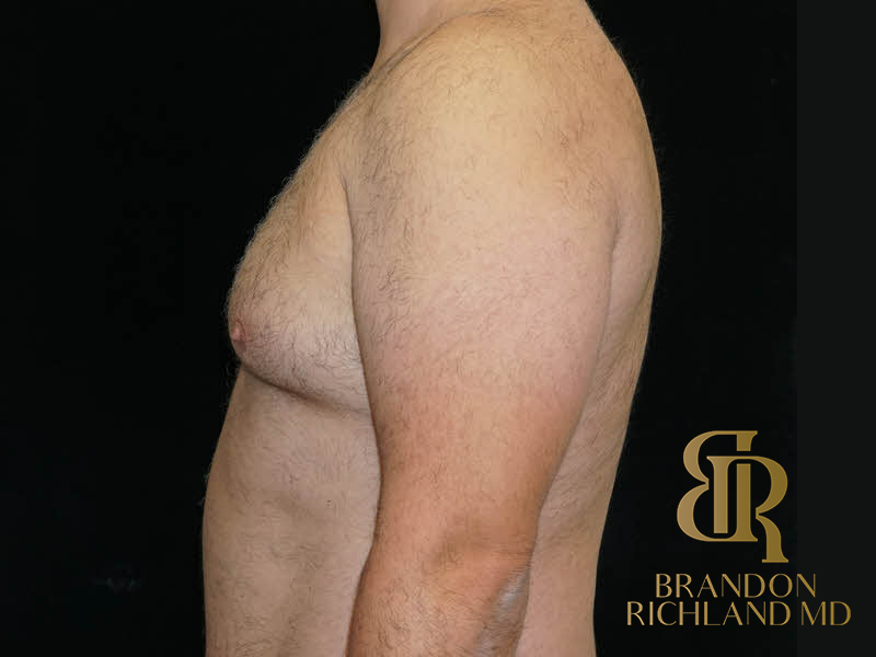 Gynecomastia Surgery Before & After Image