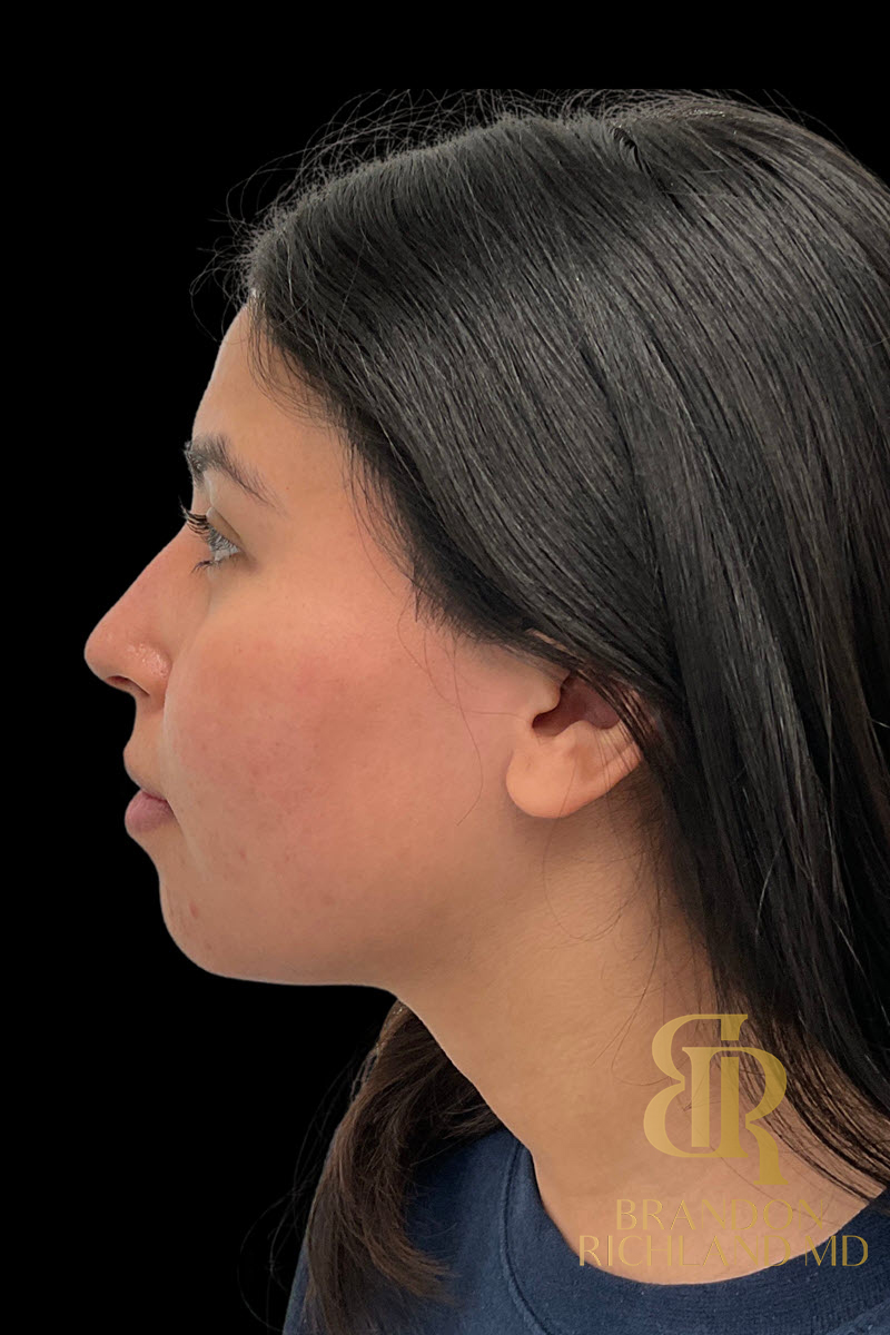 Chin Augmentation Before & After Image